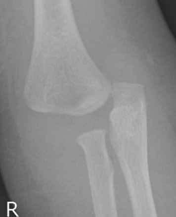 Distal physis