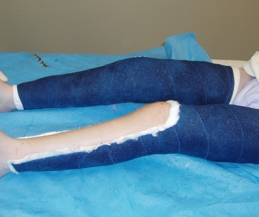 CP knee