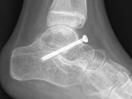 CP hindfoot
