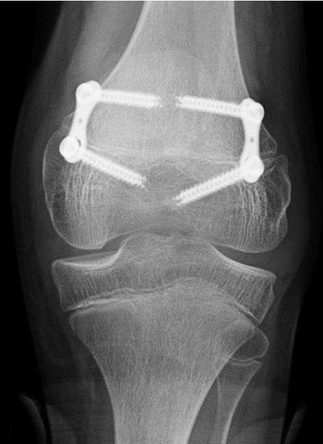 CP knee