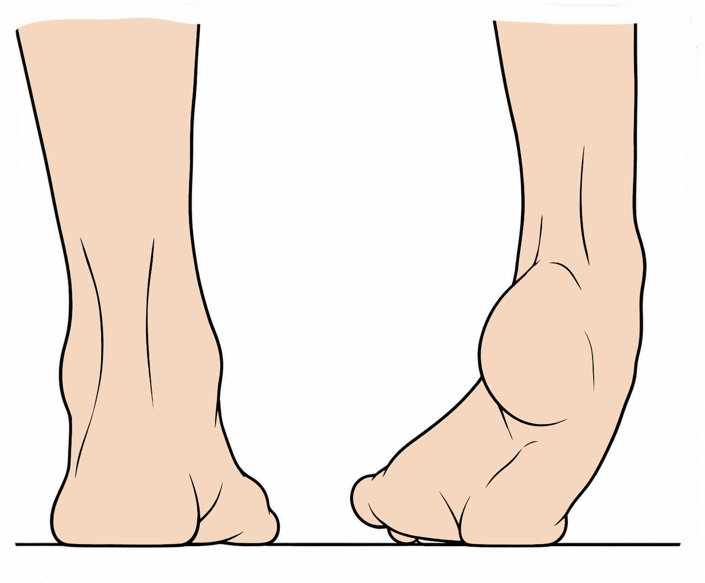 Equinovarus