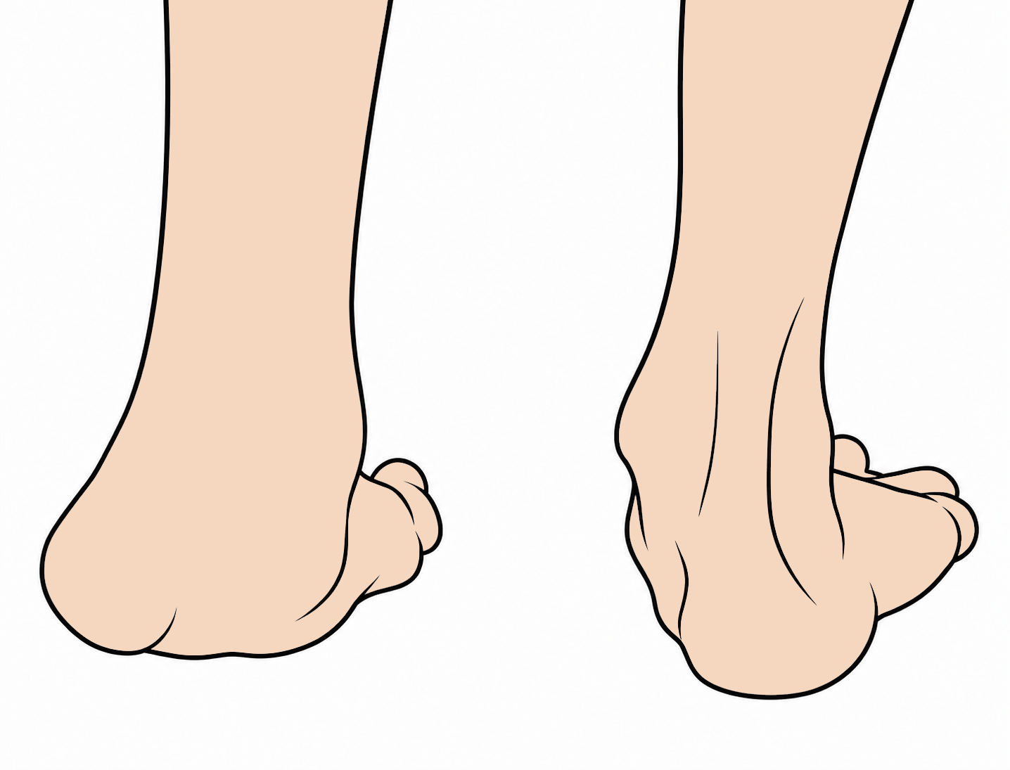 Equinovarus