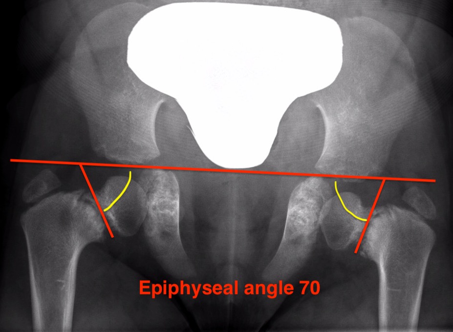 Epiphyseal angle 
