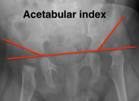 Acetabular index
