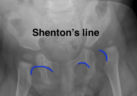 Shenton's line