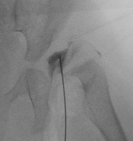 DDH arthrogram