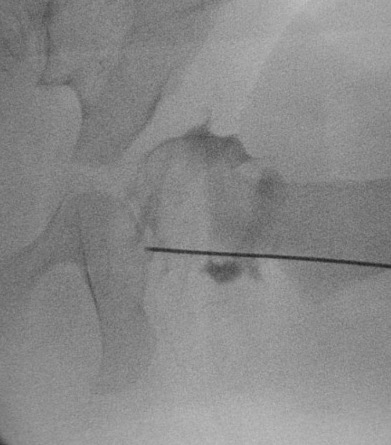 DDH arthrogram