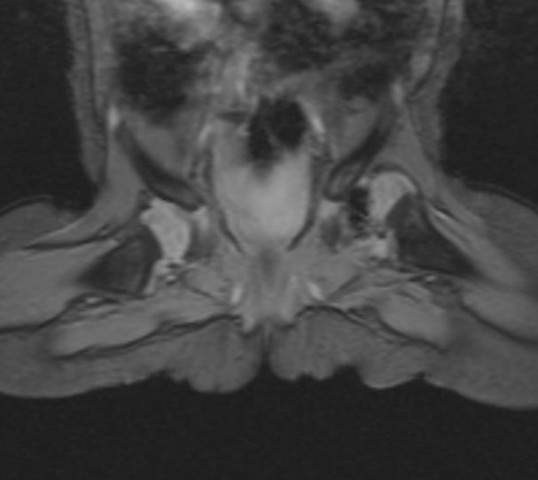 DDH MRI