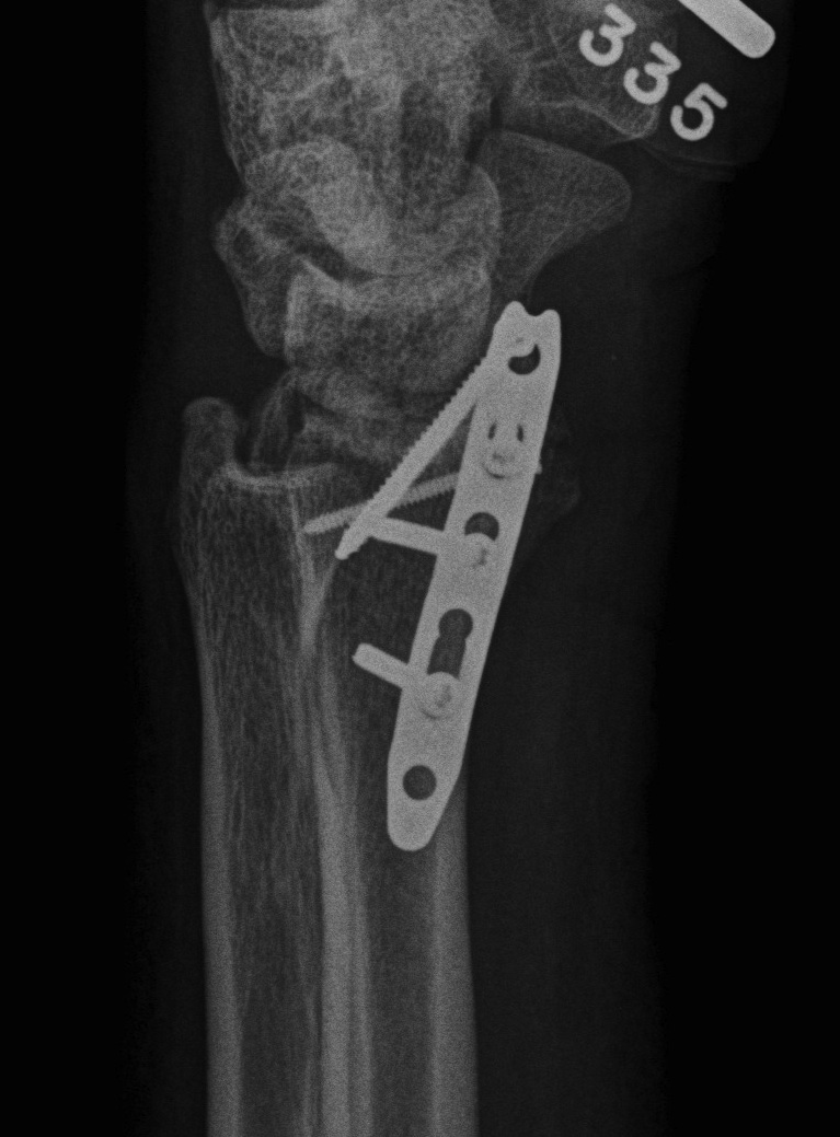 Radial styloid