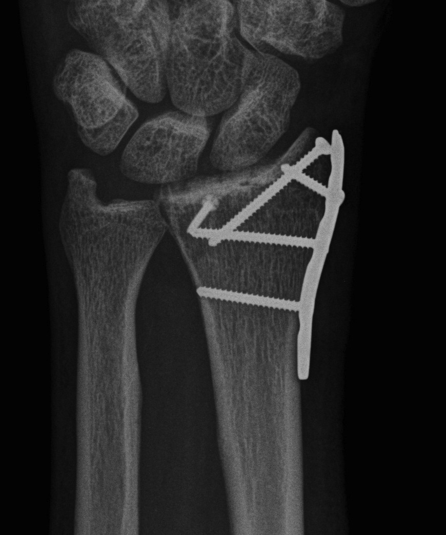 radial styloid