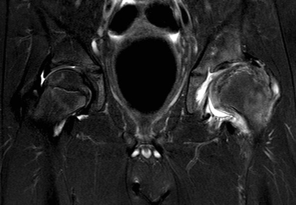 MRI Perthes
