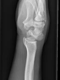 Perilunate dislocation