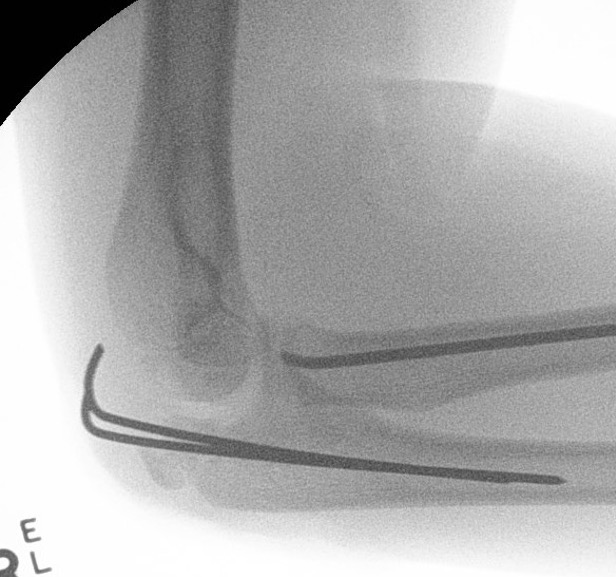 Radial neck olecranon
