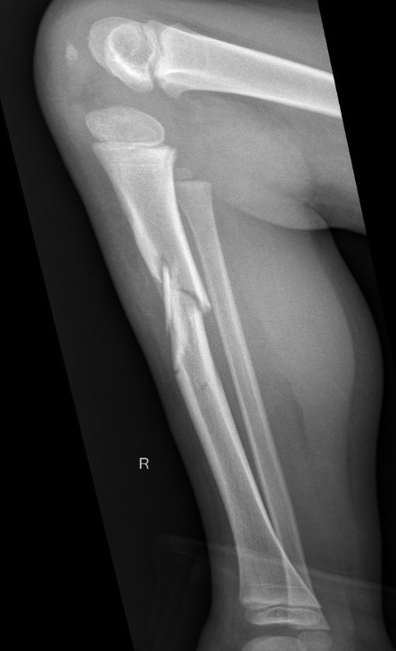 tibia