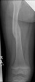 femur