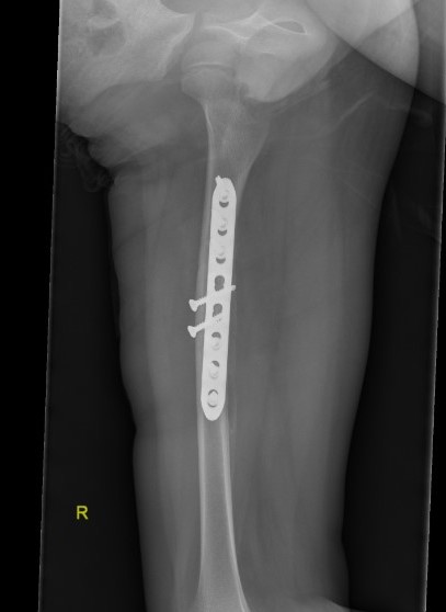 femur plate