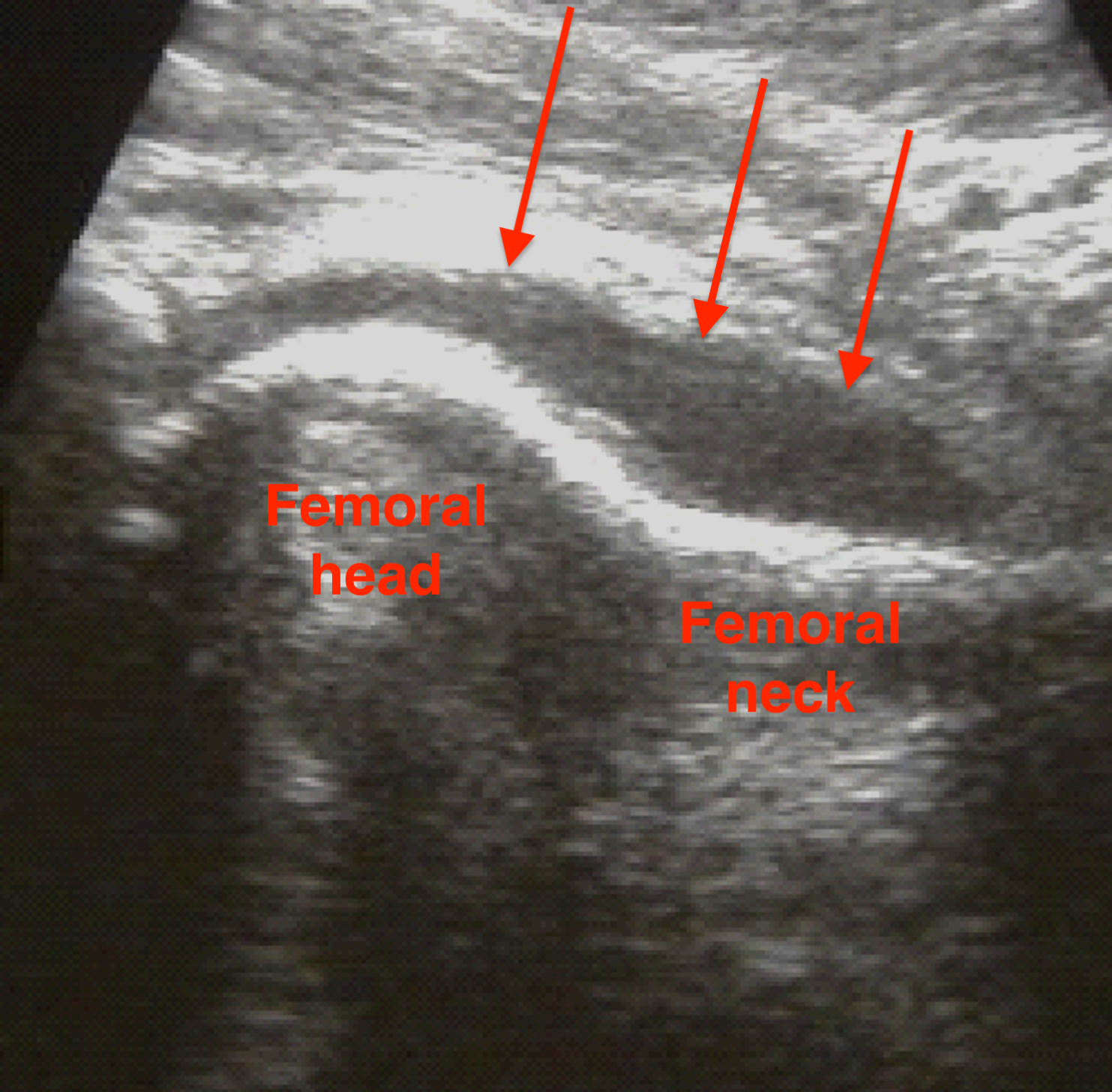 Hip ultrasound