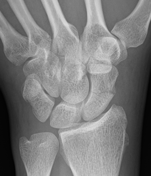 scaphoid