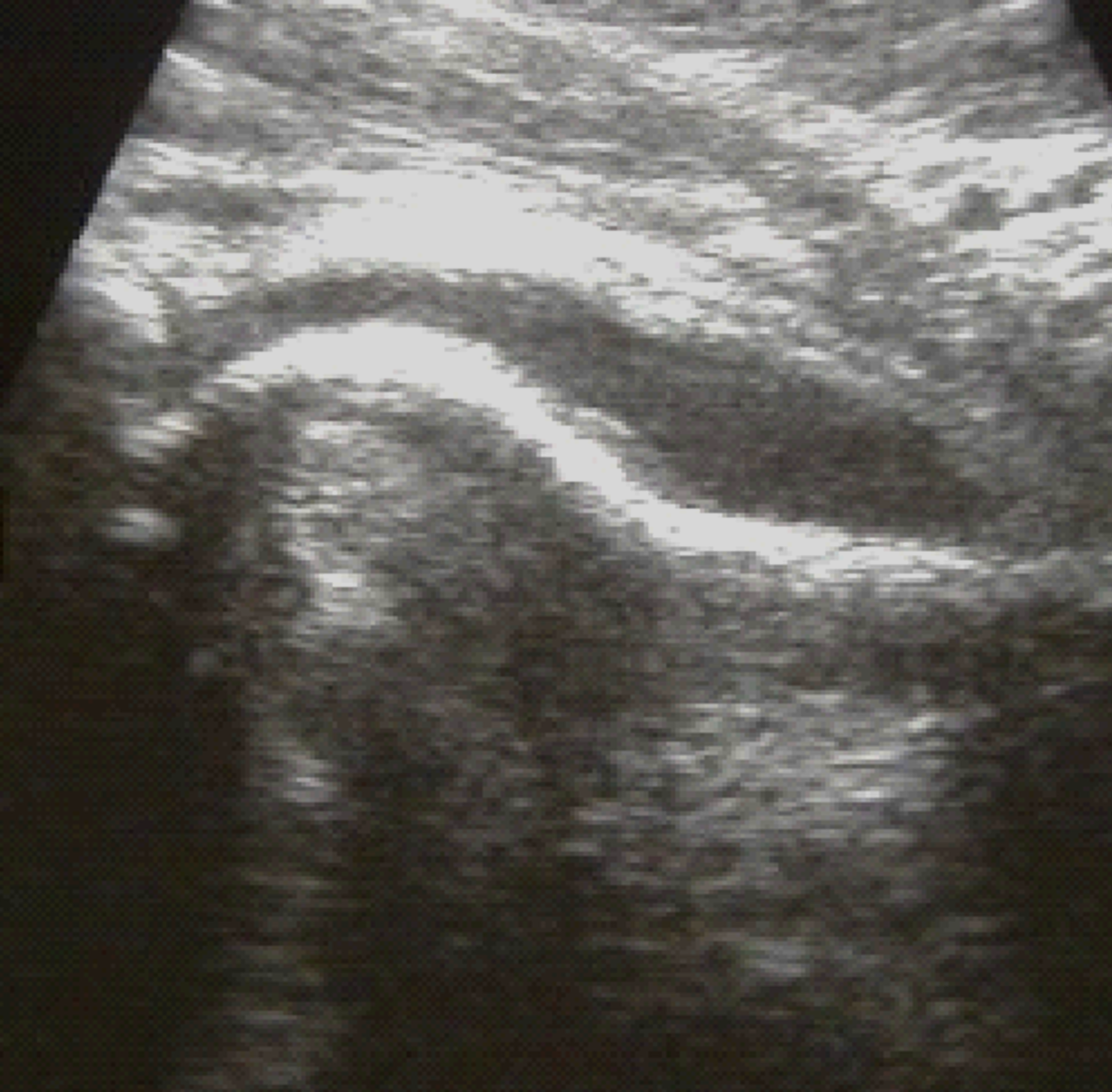Hip ultrasound