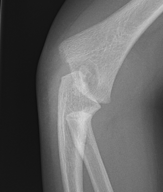 Distal physeal separation