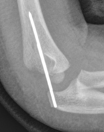 distal physeal