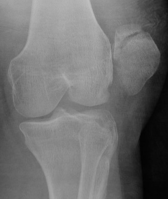 Patella OCF