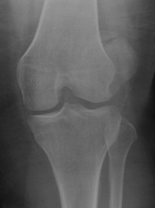 Patella OCF
