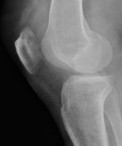 patella ocf