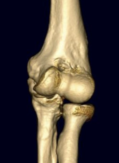 CT cubuitus varus