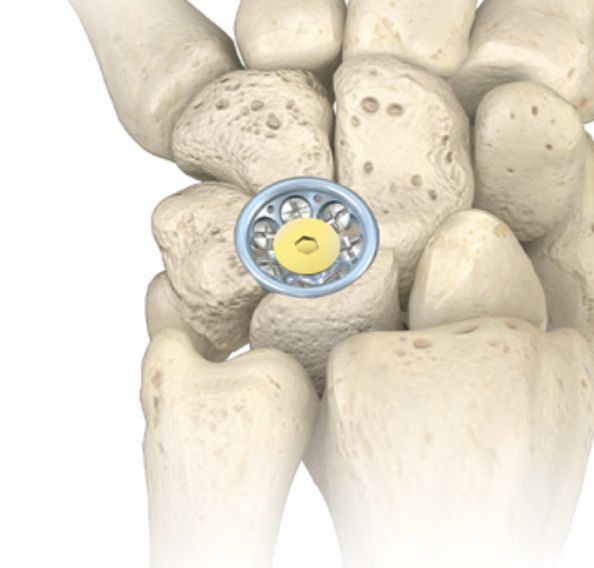 Acumed 4 corner fusion plate