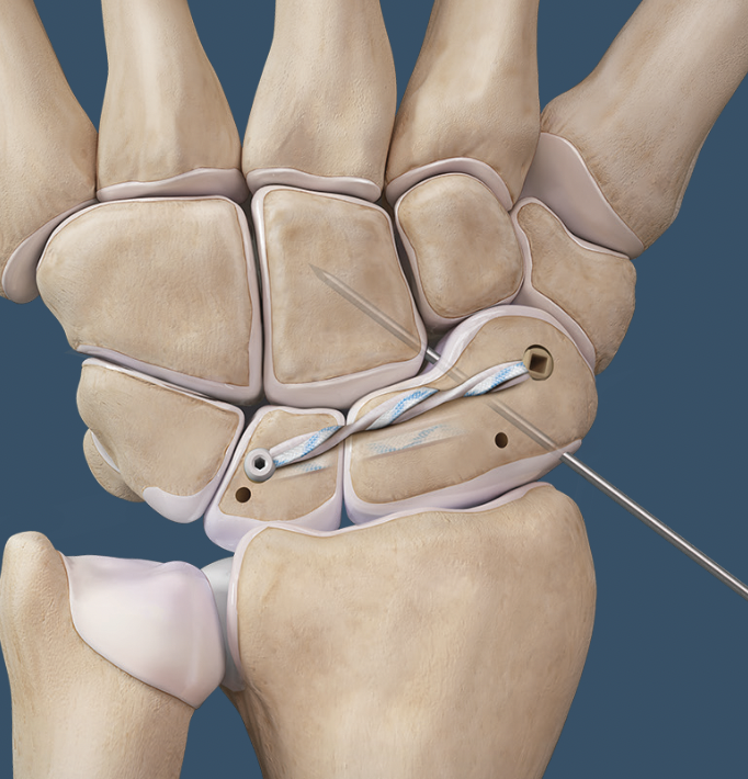 Arthrex interosseous SL