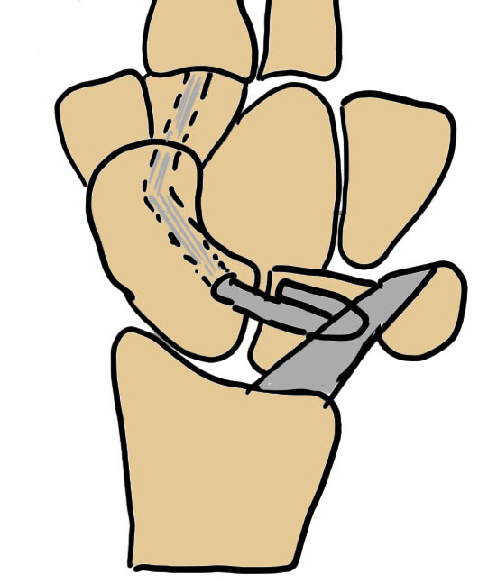 3-ligament