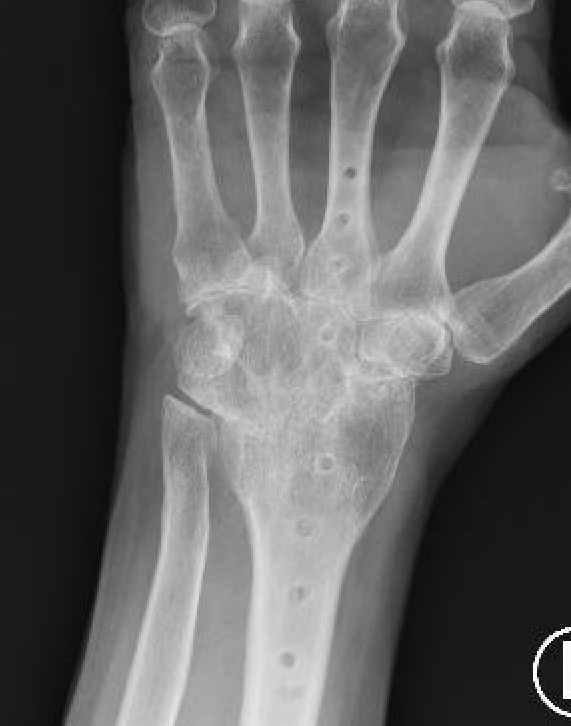 wrist arthro