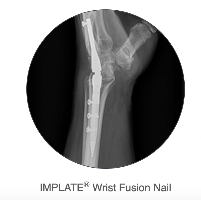 wrist nail