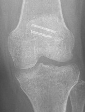 Patella ORIF