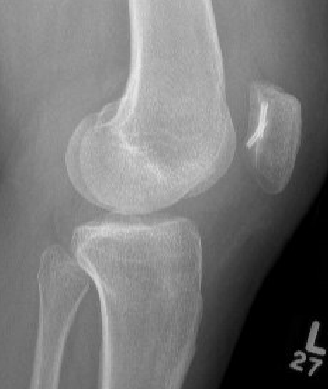 Patella ORIF
