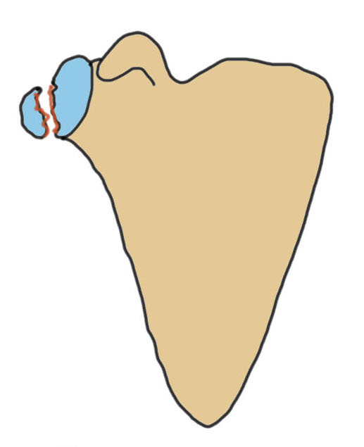 Glenoid fractures | The Bone School