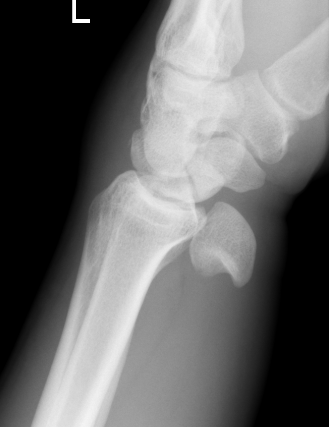 Lunate dislocation