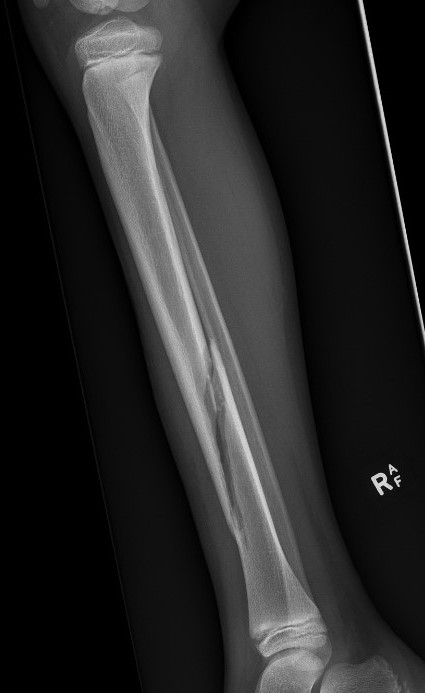 tibia