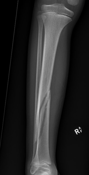 tibia