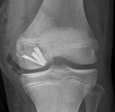 Hoffa fracture | The Bone School