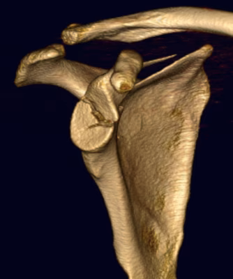 Glenoid Fracture 3
