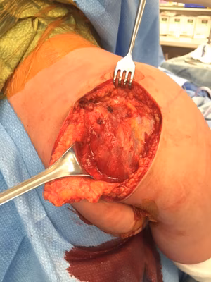 Posterior approach shoulder 