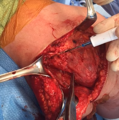 Posterior approach shoulder 3