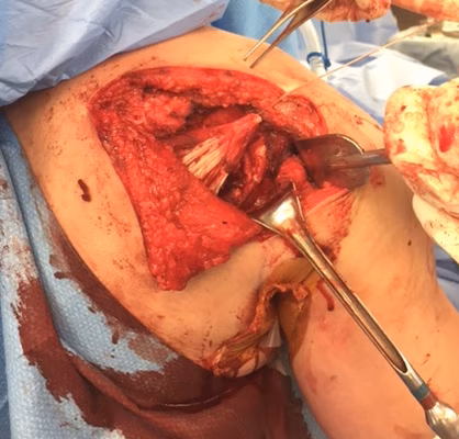 Posterior approach shoulder 5