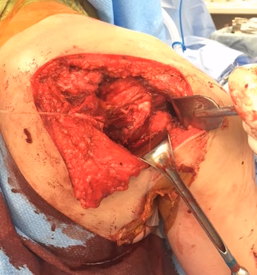 Posterior approach shoulder 6
