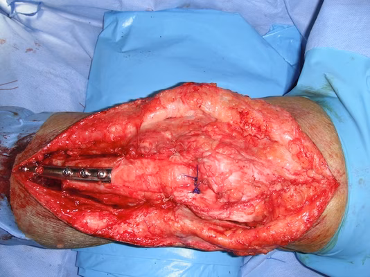 Proximalization tibial tuberosity 2