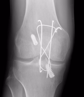 ACL BPTB Patella ORIF AP