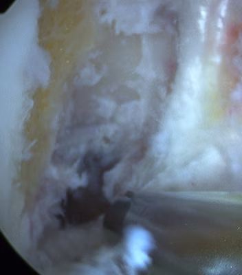 ACL Post Notchplasty