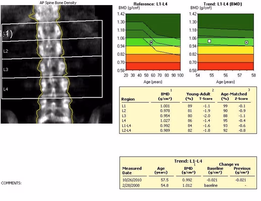 BMD Spine